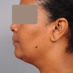 Neck Liposuction / Chin Liposuction Before & After Patient #1930