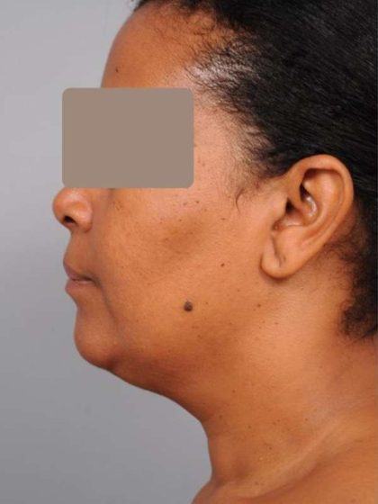 Neck Liposuction / Chin Liposuction Before & After Patient #1930