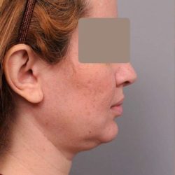 Neck Liposuction / Chin Liposuction Before & After Patient #1946