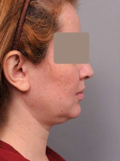 Neck Liposuction / Chin Liposuction Before & After Patient #1946