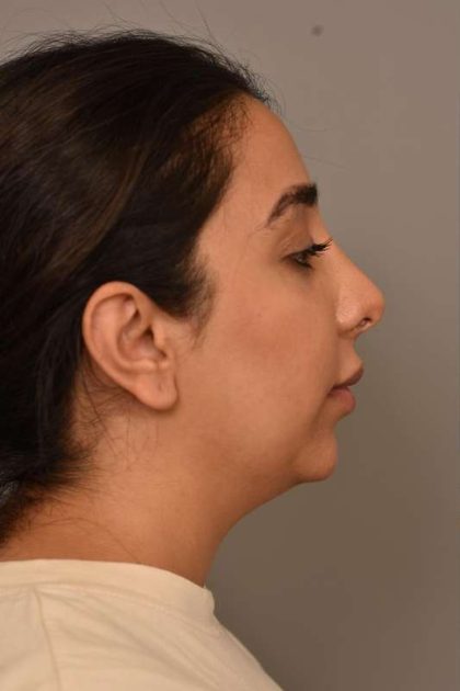 Neck Liposuction / Chin Liposuction Before & After Patient #1953