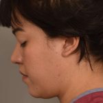 Neck Liposuction / Chin Liposuction Before & After Patient #1958