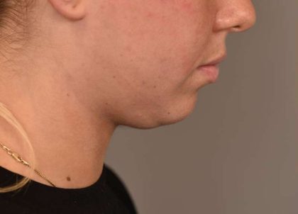 Neck Liposuction / Chin Liposuction Before & After Patient #1983