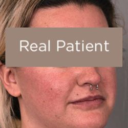 Neck Liposuction / Chin Liposuction Before & After Patient #2002