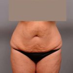 Tummy Tuck Before & After Patient #402