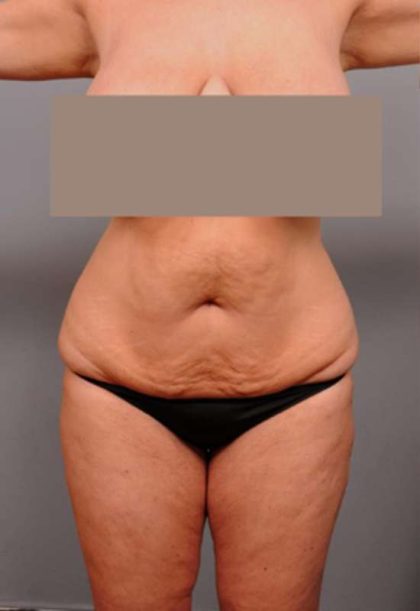 Tummy Tuck Before & After Patient #402