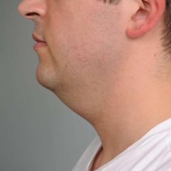 Neck Liposuction / Chin Liposuction Before & After Patient #2027