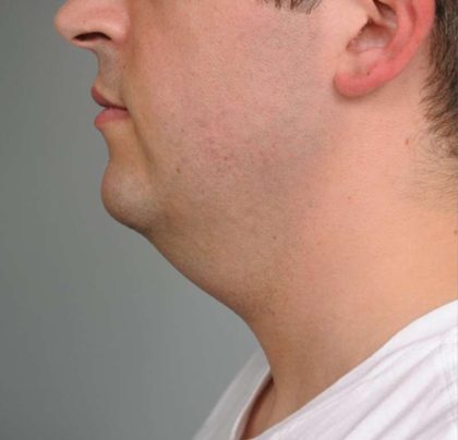 Neck Liposuction / Chin Liposuction Before & After Patient #2027