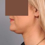 Neck Liposuction / Chin Liposuction Before & After Patient #2034
