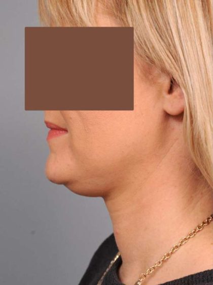 Neck Liposuction / Chin Liposuction Before & After Patient #2034