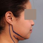 Neck Liposuction / Chin Liposuction Before & After Patient #2046