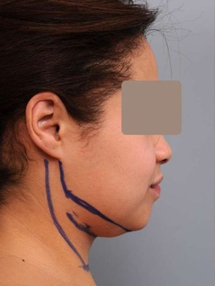 Neck Liposuction / Chin Liposuction Before & After Patient #2046