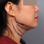 Neck Liposuction / Chin Liposuction Before & After Patient #2051