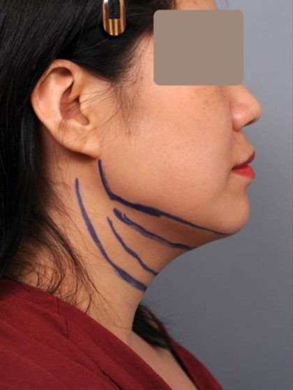 Neck Liposuction / Chin Liposuction Before & After Patient #2051