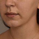 Buccal Fat Removal Before & After Patient #2066