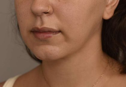 Buccal Fat Removal Before & After Patient #2066