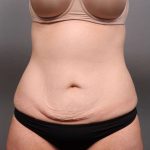 Tummy Tuck Before & After Patient #411