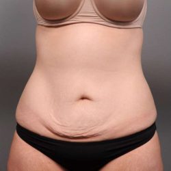 Tummy Tuck Before & After Patient #411