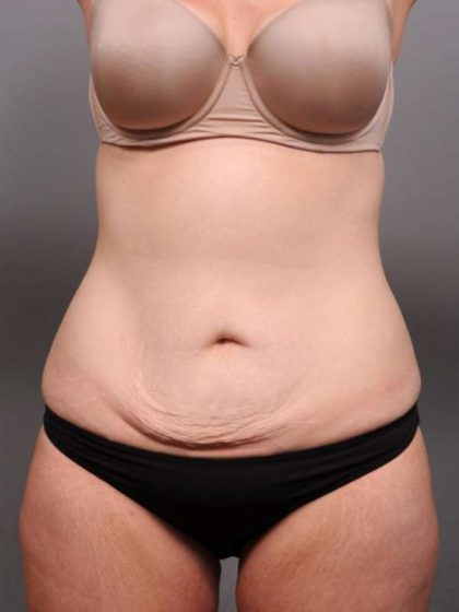 Tummy Tuck Before & After Patient #411