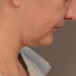Buccal Fat Removal Before & After Patient #2080