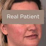 Buccal Fat Removal Before & After Patient #2108