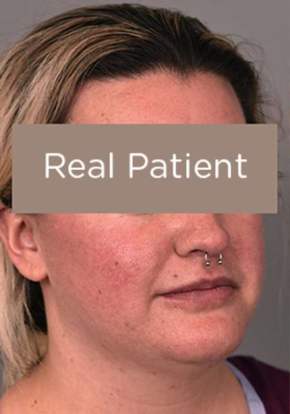 Buccal Fat Removal Before & After Patient #2108