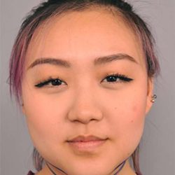 Buccal Fat Removal Before & After Patient #2118