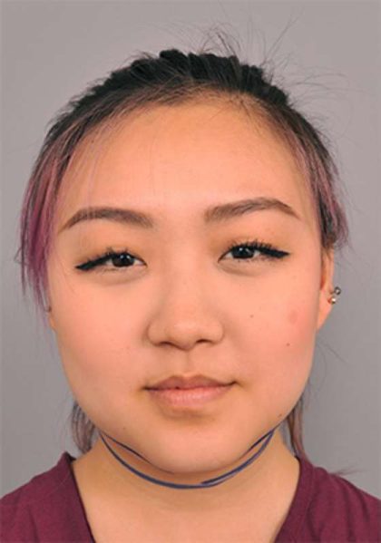 Buccal Fat Removal Before & After Patient #2118