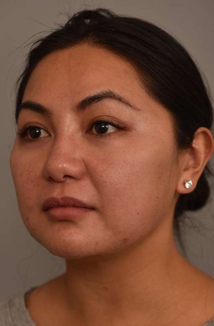 Cheek Liposuction Before & After Patient #2136