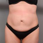 Tummy Tuck Before & After Patient #418