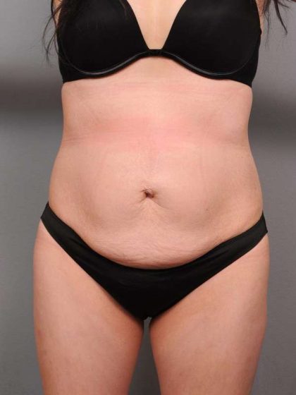 Tummy Tuck Before & After Patient #418