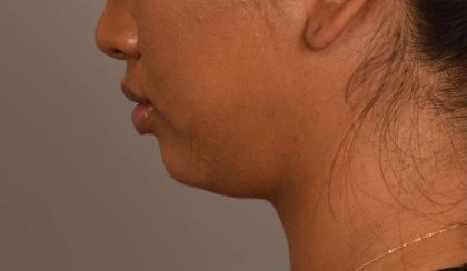 Cheek Liposuction Before & After Patient #2144
