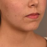 Cheek Liposuction Before & After Patient #2149