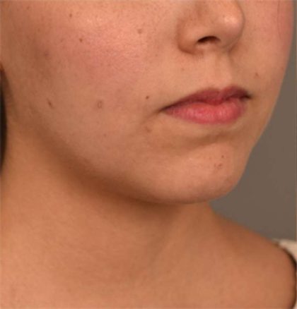 Cheek Liposuction Before & After Patient #2149