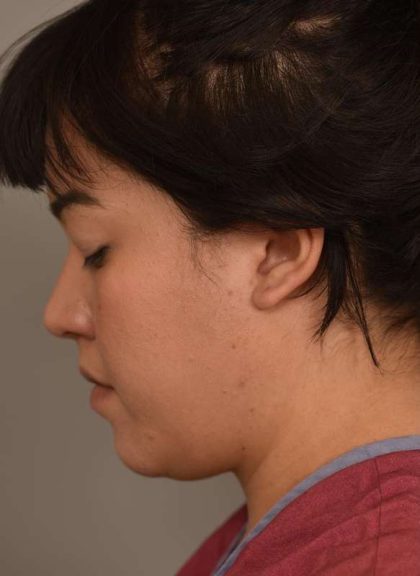 Cheek Liposuction Before & After Patient #2154