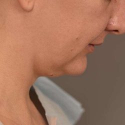 Cheek Liposuction Before & After Patient #2165
