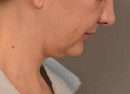 Cheek Liposuction Before & After Patient #2165