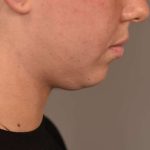 Cheek Liposuction Before & After Patient #2170