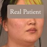 Cheek Liposuction Before & After Patient #2179
