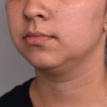 Cheek Liposuction Before & After Patient #2197
