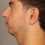 Chin Implant Before & After Patient #2203