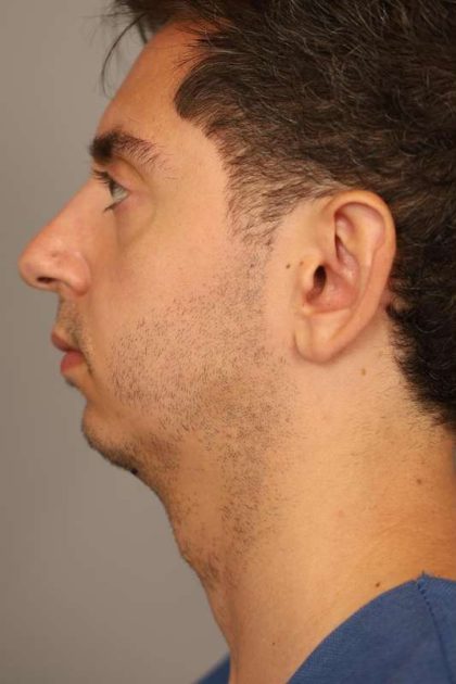 Chin Implant Before & After Patient #2203