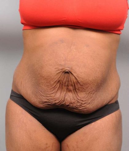 Tummy Tuck Before & After Patient #427