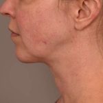 Chin Implant Before & After Patient #2220