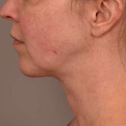 Chin Implant Before & After Patient #2220