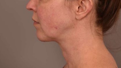 Chin Implant Before & After Patient #2220