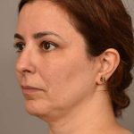 Chin Implant Before & After Patient #2227
