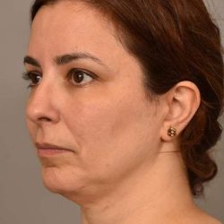 Chin Implant Before & After Patient #2227
