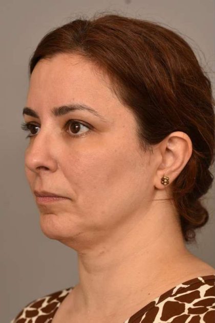 Chin Implant Before & After Patient #2227