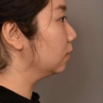 Chin Implant Before & After Patient #2234